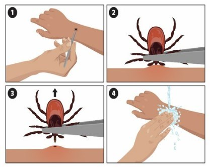 Tick Removal Guide from the CDC.